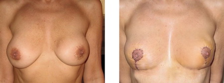 ablation d'implants mammaires vue de profil 