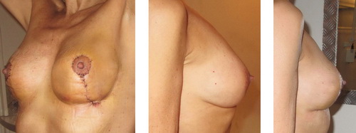 ablation d'implants mammaires détail de la cicatrice et vue de profil 