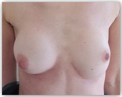 patiente opérée il y a 18 ans d'une augmentation mammaire présentant une rétraction péri-prothétique droite