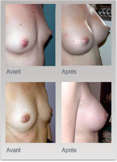 Exemple d'augmentations mammaires par pose d'implants mammaire