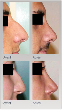 Exemples de rhinoplasties esthétiques chez l'homme et la femme