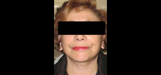 chirurgie-esthetique-interventions-visage-liftings