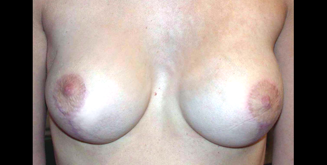 chirurgie-esthetique-interventions-seins-correction-ptose-avec-implants