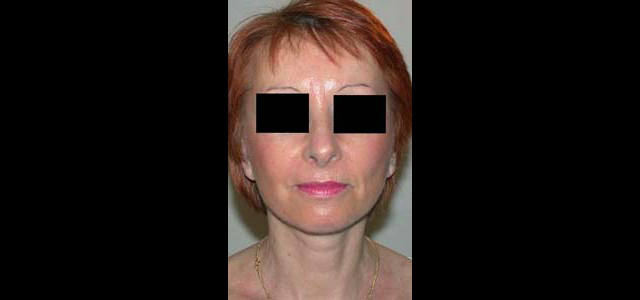 chirurgie-esthetique-interventions-visage-liftings