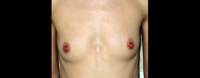 chirurgie-esthetique-interventions-seins-augmentations-mammaires