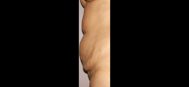 chirurgie-esthetique-interventions-abdomens-abdominoplasties