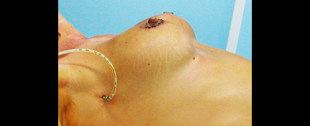 chirurgie-esthetique-interventions-seins-augmentations-mammaires