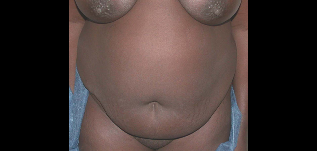 chirurgie-esthetique-interventions-abdomens-abdominoplasties