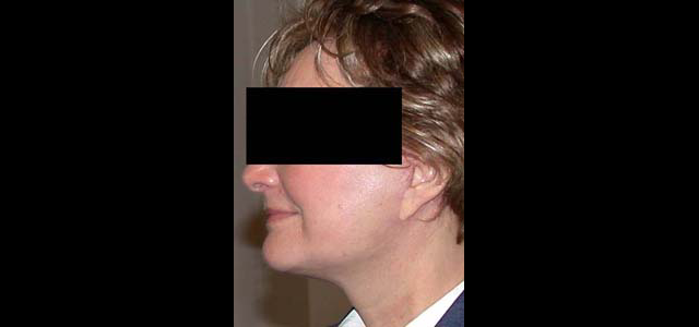 chirurgie-esthetique-interventions-visage-liftings