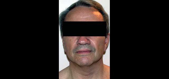 chirurgie-esthetique-interventions-visage-liftings
