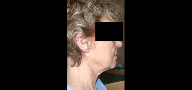 chirurgie-esthetique-interventions-visage-liftings