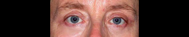 chirurgie-esthetique-interventions-paupieres-blépharoplasties