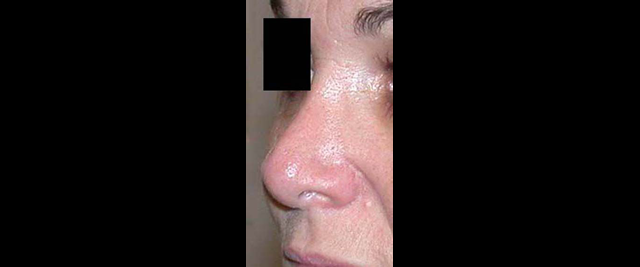 chirurgie-esthetique-chirurgie-secondaire-nez-rhinoplastie-secondaire