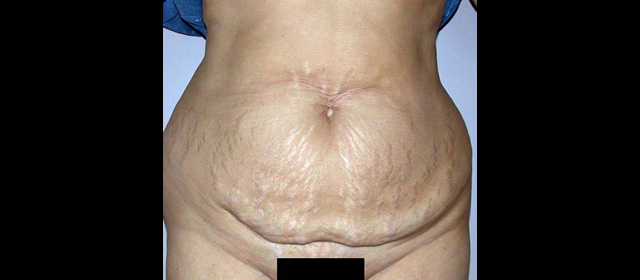 chirurgie-esthetique-interventions-abdomens-abdominoplasties