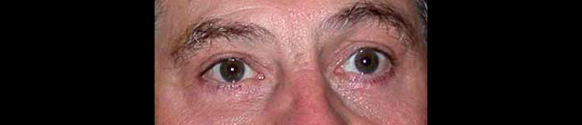 chirurgie-esthetique-interventions-paupieres-blépharoplasties