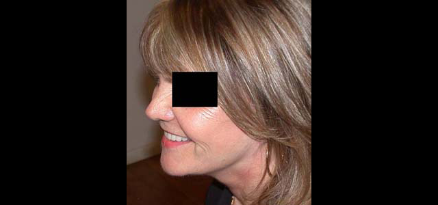 chirurgie-esthetique-interventions-visage-liftings