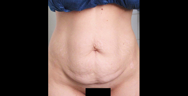 chirurgie-esthetique-interventions-abdomens-abdominoplasties