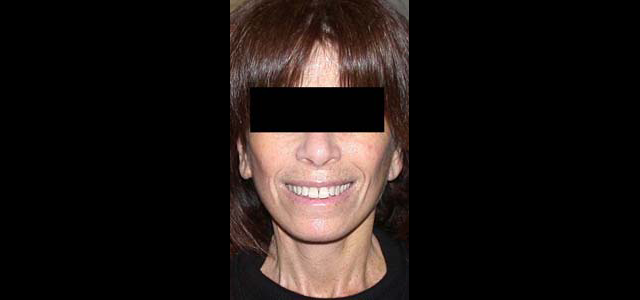 chirurgie-esthetique-interventions-visage-liftings