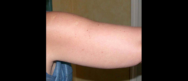 chirurgie-esthetique-interventions-lipoaspirations-liposuccions