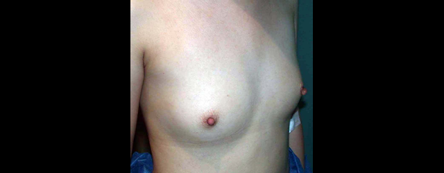 chirurgie-esthetique-interventions-seins-augmentations-mammaires