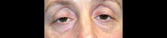 chirurgie-esthetique-interventions-paupieres-blépharoplasties