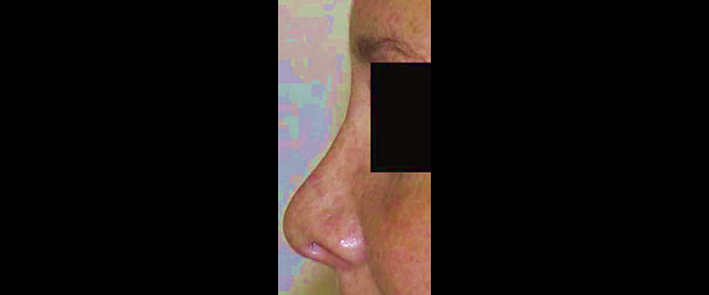 chirurgie-esthetique-chirurgie-secondaire-nez-rhinoplastie-secondaire