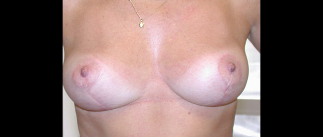chirurgie-esthetique-interventions-seins-ptoses-mammaires-sans-implant
