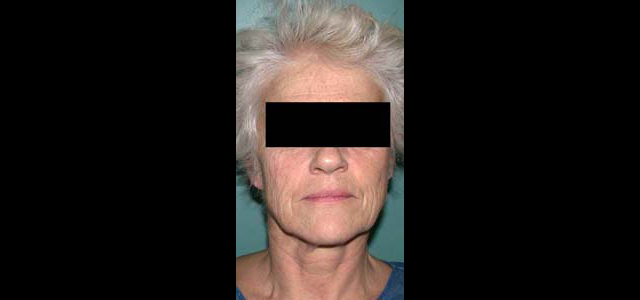 chirurgie-esthetique-interventions-visage-liftings