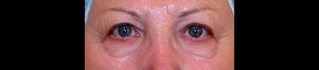 chirurgie-esthetique-interventions-paupieres-blépharoplasties