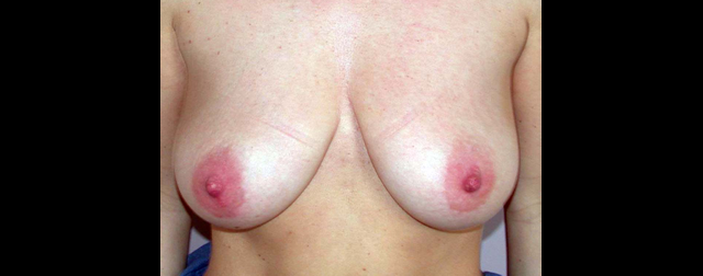 chirurgie-esthetique-interventions-seins-ptoses-mammaires-sans-implant