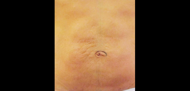 chirurgie-esthetique-interventions-abdomens-abdominoplasties