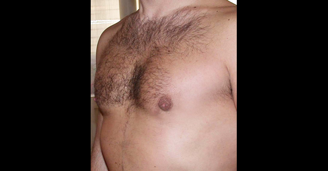 chirurgie-esthetique-interventions-gynecomasties