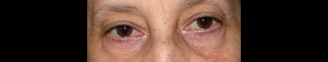 chirurgie-esthetique-interventions-paupieres-blépharoplasties