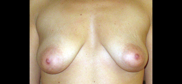 chirurgie-esthetique-interventions-seins-correction-ptose-avec-implants