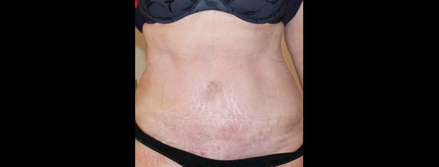 chirurgie-esthetique-interventions-abdomens-abdominoplasties