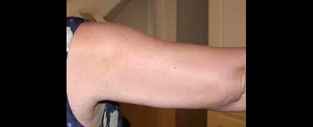chirurgie-esthetique-interventions-lipoaspirations-liposuccions