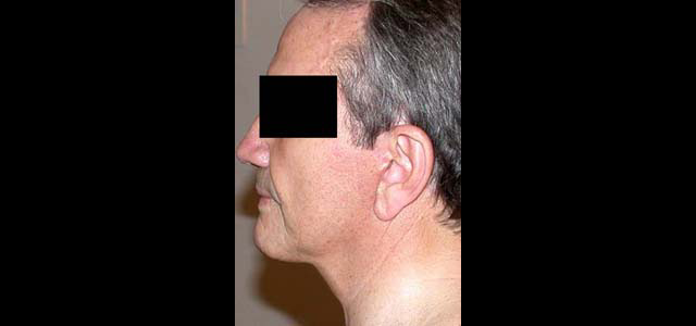 chirurgie-esthetique-interventions-visage-liftings