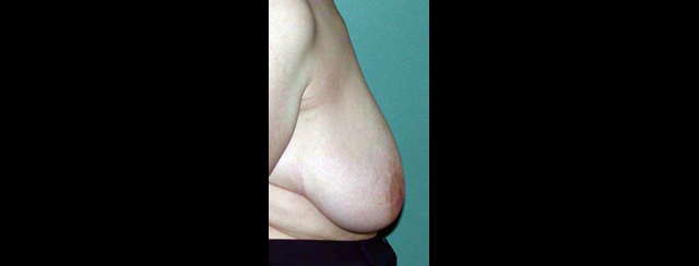 chirurgie-esthetique-interventions-seins-reductions-mammaires