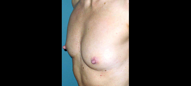 chirurgie-esthetique-interventions-seins-augmentations-mammaires