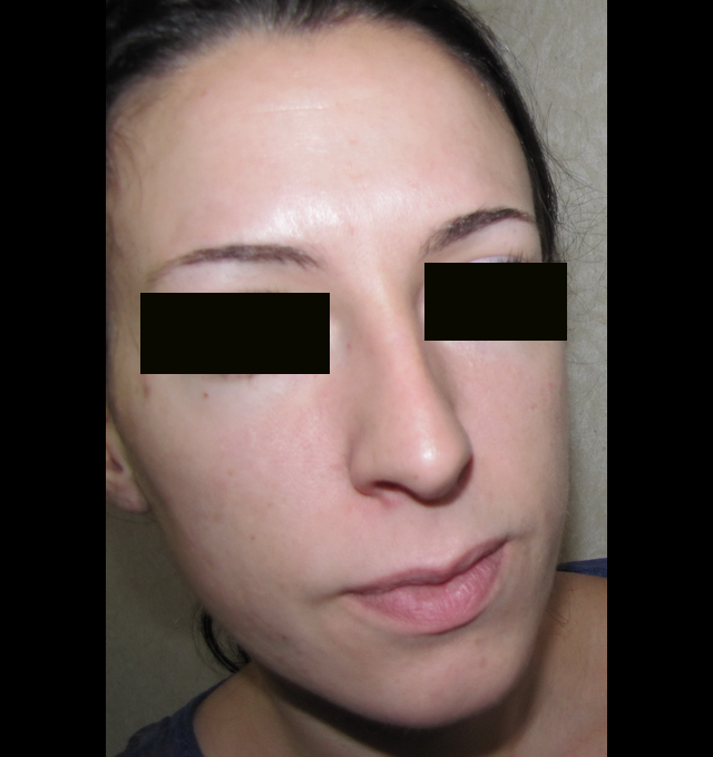 demande d'implants malaires et rhinoplastie