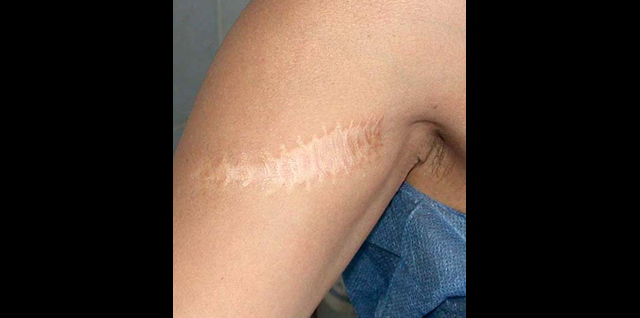 chirurgie-esthetique-interventions-cicatrices-grains-beauté-kystes-tatouages