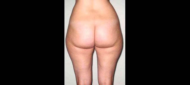 chirurgie-esthetique-interventions-lipoaspirations-liposuccions