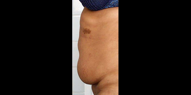 chirurgie-esthetique-interventions-abdomens-abdominoplasties