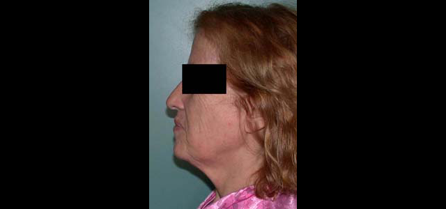 chirurgie-esthetique-interventions-visage-liftings