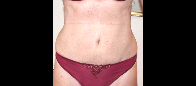 chirurgie-esthetique-interventions-lipoaspirations-liposuccions