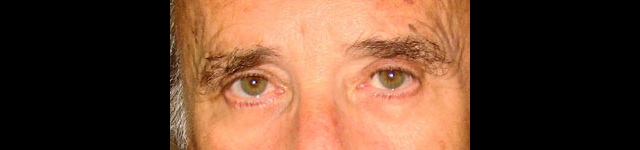 chirurgie-esthetique-interventions-paupieres-blépharoplasties