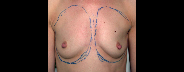 chirurgie-esthetique-interventions-seins-augmentations-mammaires