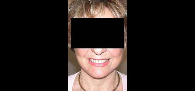 chirurgie-esthetique-interventions-visage-liftings