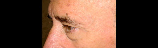 chirurgie-esthetique-interventions-paupieres-blépharoplasties