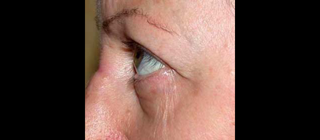 chirurgie-esthetique-interventions-paupieres-blépharoplasties